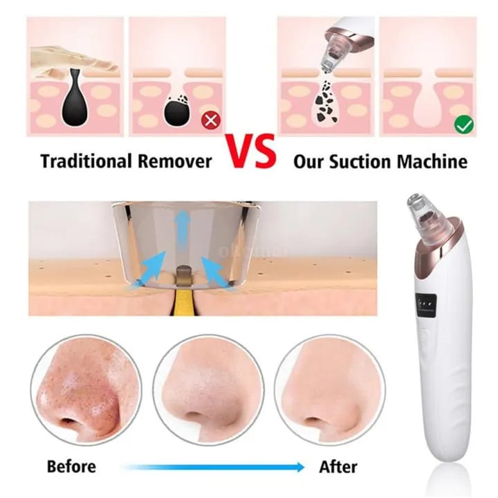 Blackhead Remover Vacuum Acne Cleaner Black Spots Removal